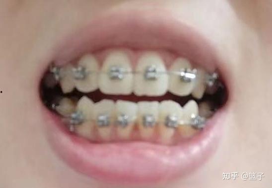 成人反咬合矫正视频,视频教程解析与实操指南-第1张图片-午夜影院