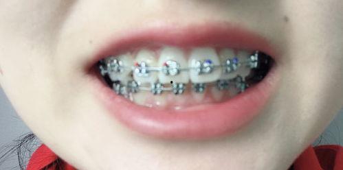 成人反咬合矫正视频,视频教程解析与实操指南-第2张图片-午夜影院