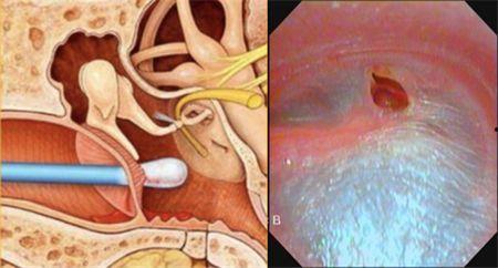 成人怎么洗耳屎视频,轻松掌握成人洗耳屎的正确方法-第2张图片-午夜影院